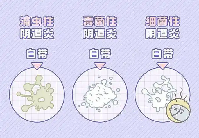 其次是滴虫性阴道炎,它的症状是白带增多,呈乳白色或黄色,有时为脓性