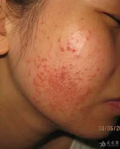 这是什么病马拉色菌毛囊炎