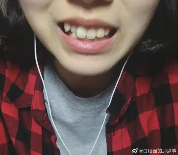 267天~龅牙嘴凸明显改善】打卡打卡~坐标成都,我的牙齿是深覆盖加虎牙