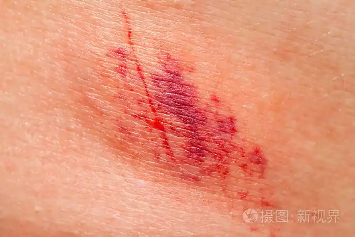 人皮肤疼痛皮下损伤的特写图片