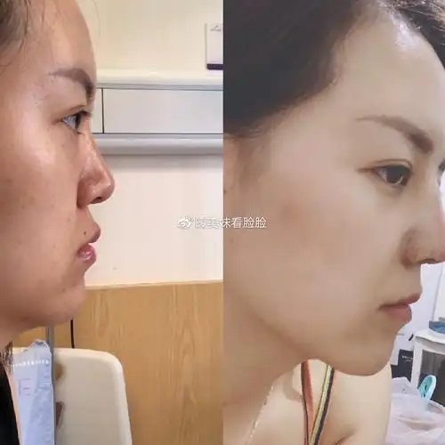 打过玻尿酸的鼻子再做肋骨鼻术后9天看都很难达到理想中的效果