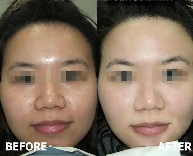 激光美白哪里好?汕头华美整形来帮你