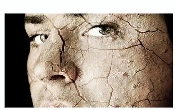 干燥综合症的临床表现有哪些图1