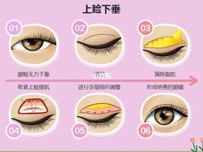 上睑下垂矫正手术,通过调节提肌力量恢复提肌功能,可以让昏昏欲睡的小