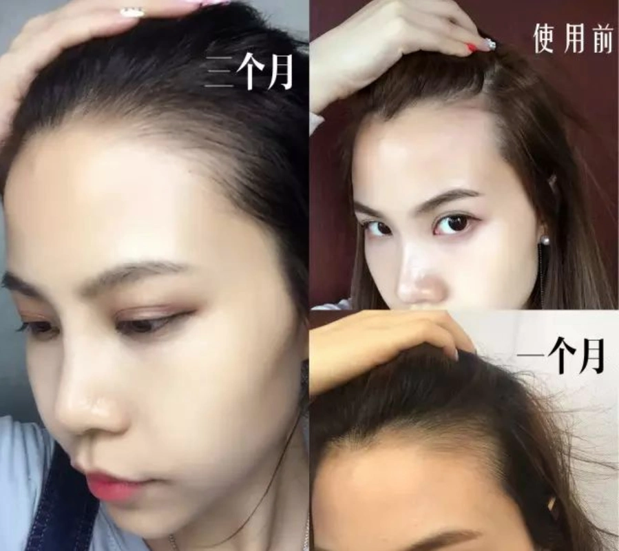 两款"生发利器"可以拯救发际线 | 钛空舱