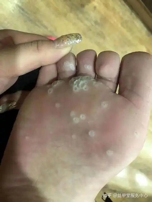 益甲堂专业祛跖疣1,用专业修脚工具修理增厚角质层及坏死组织.