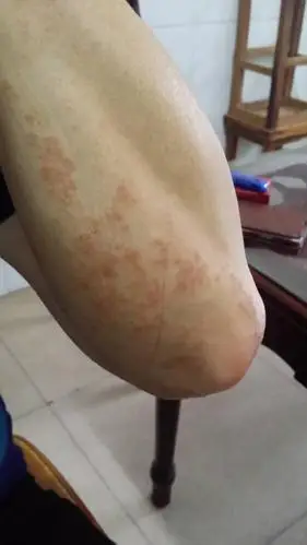 最近手臂长了好多块红疙瘩,看了医生说是湿疹,涂了皮炎平,好了点