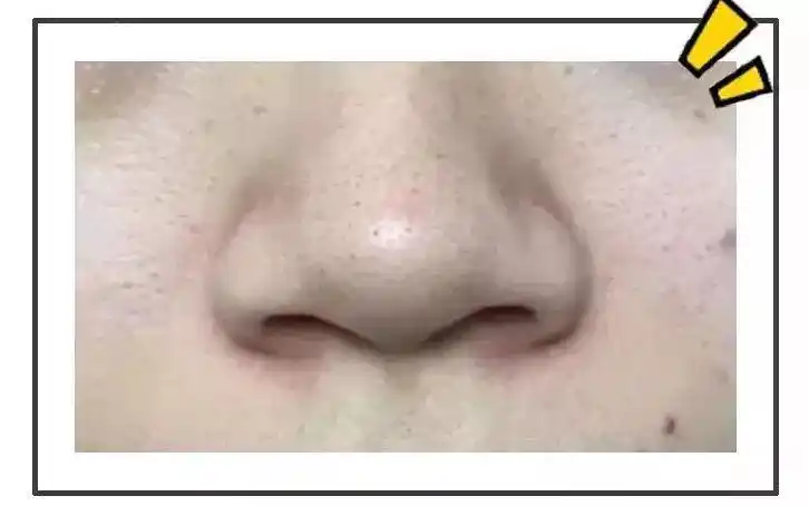 不要草莓鼻,用这个"毛孔吸尘器",黑头粉刺全吸走!