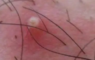 毛囊炎可由细菌,真菌,病毒等感染引起.