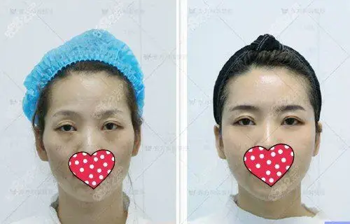 北京东方和谐冯斌全脸脂肪填充术前术后对比照