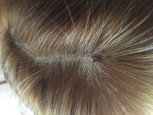 我2天连续染了3次头发,完了之后头皮起了一块黑色的痂是怎么回