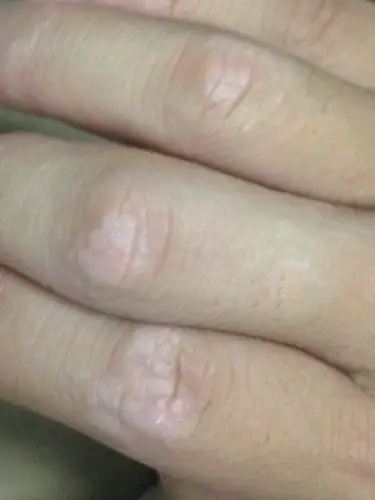 问:手痒,脱皮,指节发白…这种情况持续一阵了…想