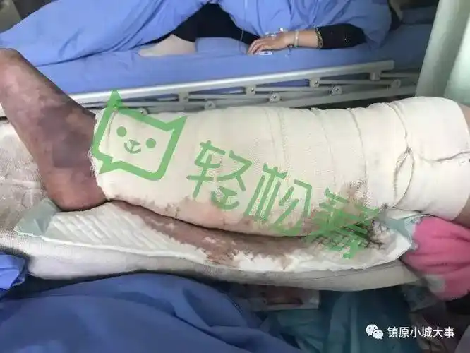 23岁的屯字新媳妇因怀孕面临着双腿截肢请热心人帮帮