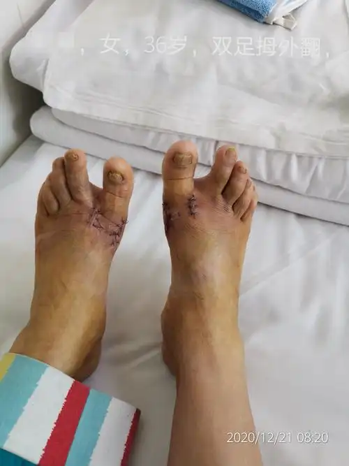 36岁双足拇外翻畸形矫正手术一例