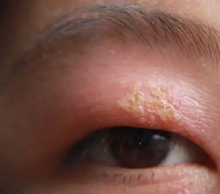 默认排序|1条回答  1 分钟前 |十二级 你这是麦粒肿,也叫针眼,眼脸炎