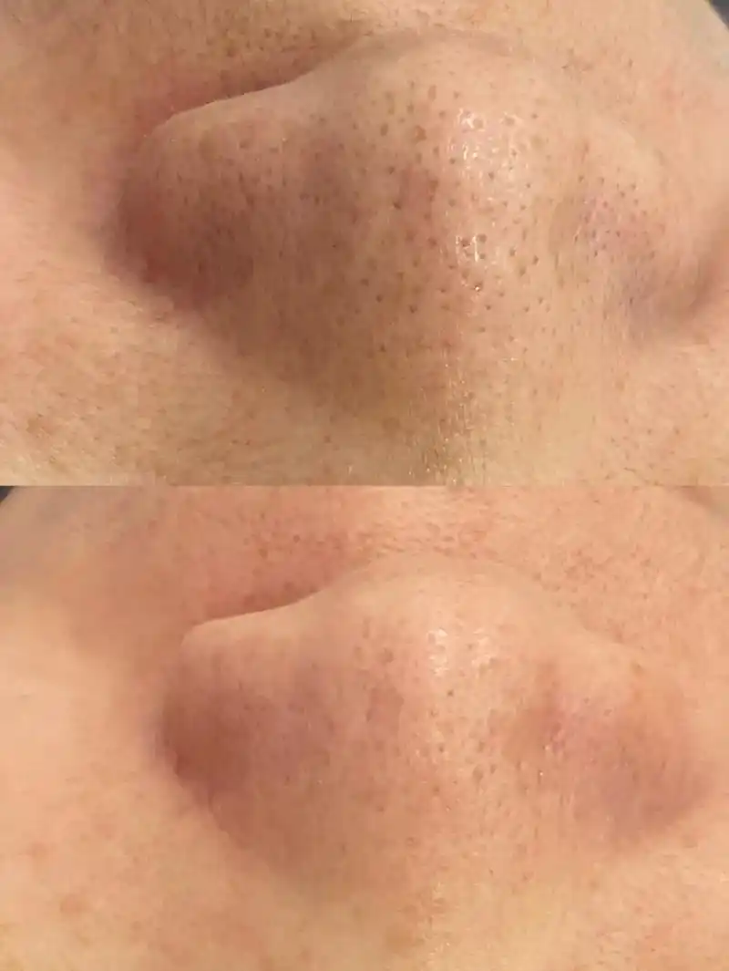 毛孔清洁前后对比图,#清洁皮肤 #护肤打卡#一起保持年轻 - 抖音