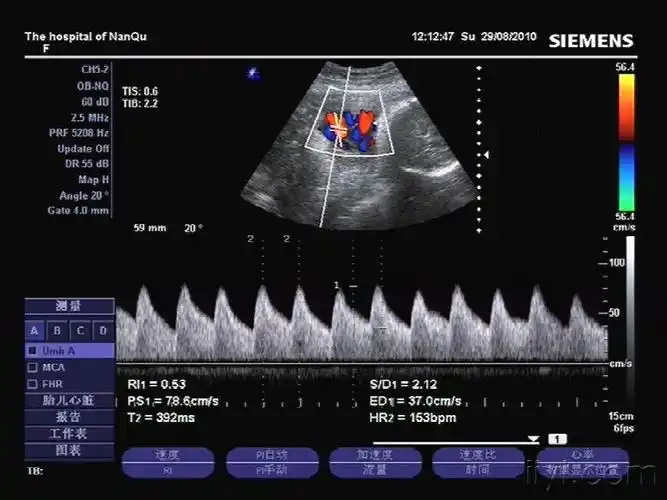 脐带绕颈四圈 - 超声医学讨论版 - 爱爱医医学论坛