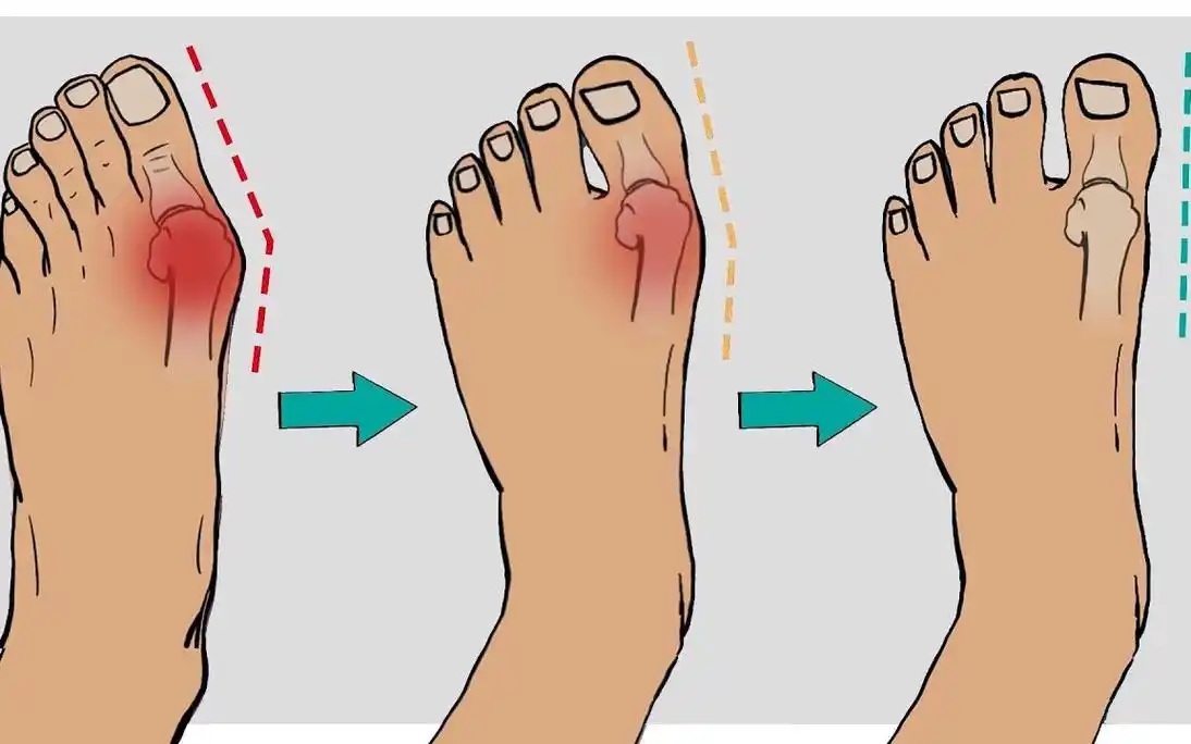 如何修复拇外翻?_哔哩哔哩_bilibili