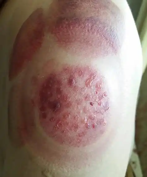 拔罐治肩周炎水去血来