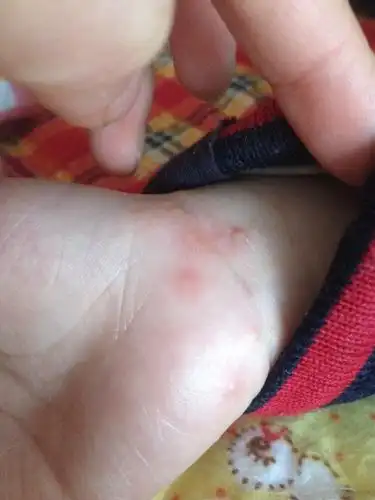 三岁小孩手上起疥疮怎样才能治疗好,求答