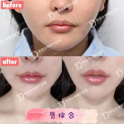 性感无辜嘟嘟唇 _圈子-新氧美容整形