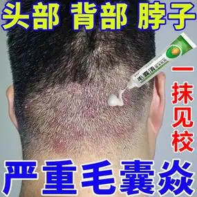 头皮毛囊炎专用药头皮有红疙瘩身上起痘痘前胸后背长痘除螨止痒膏