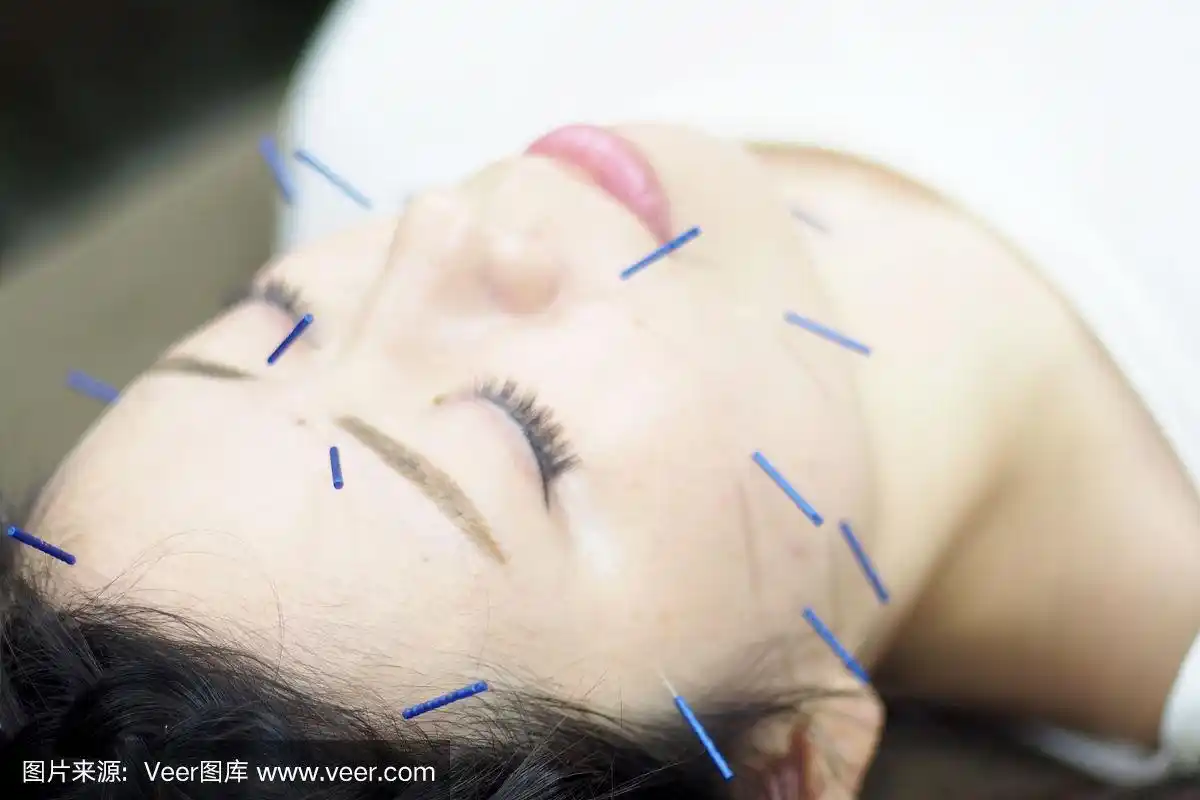 针灸,人的脸部,女人,肢体缺损,替代疗法