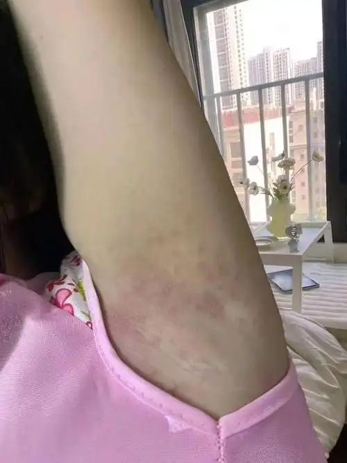 擅自使用脱毛膏,结果画蛇添足,得了毛囊炎,最后只能接受消炎治疗