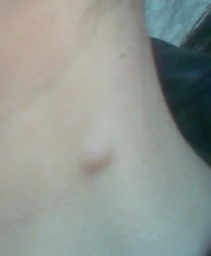 脖子上长了了一个肉疙瘩,请大家来看看是什么情况,不疼也不痒,就是看