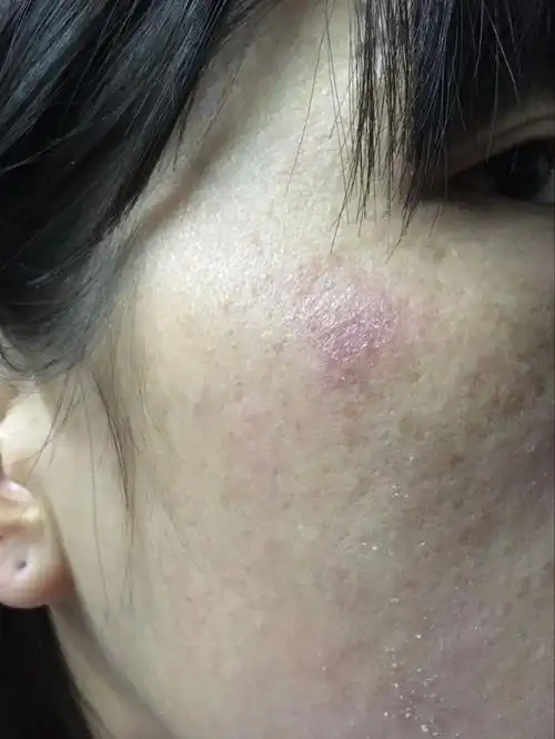脸上红红的,又很痒,摸起脸部来很粗糙,干燥并且带有脱皮现象.
