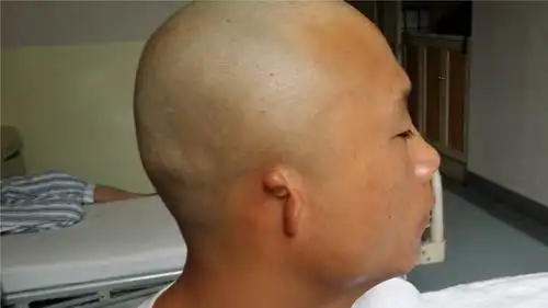 20岁小伙小耳畸形整形经历