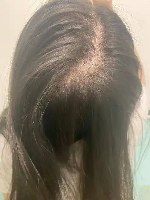 头发稀疏怎么办?亲身体验不防看看,或许对你有用_洗头_时候_秋济