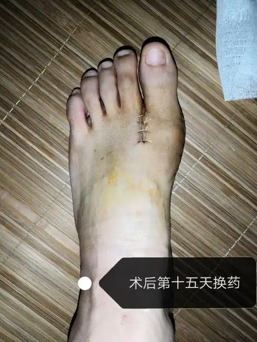 躺床上的时间太难熬了9898很多朋友问拇外翻做手术,如果脚没有