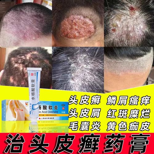 脂溢性皮炎银屑头皮屑毛囊炎大块头皮脱发 头皮癣怎么治 水杨酸软膏 3
