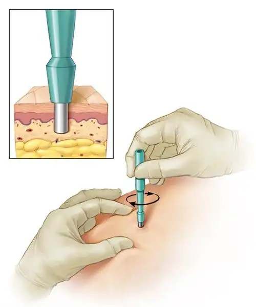 2002年richardson等人对英国肺穿刺的调查显示,在5500例记录的活检