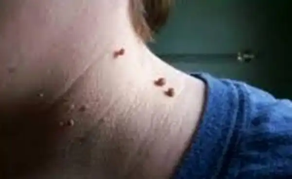 脸上一颗颗的肉瘤终於「有救了」!「这种」天然疗法在家做.