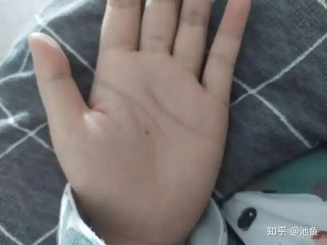 两个手都有,左手掌心痣是从出生就有的,右手是后天长出来的,别人都说