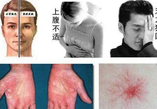 肝病全身乏力胃口差皮肤黄疸腹胀养肝护肝10个食疗方送给你