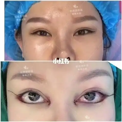 内外眼角77下至前后对比