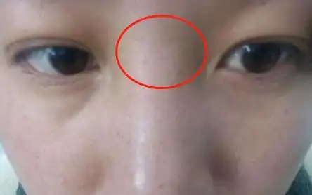 运势难以平顺,且中年婚姻易出现问题,山根有横纹的女性要注意了_网易