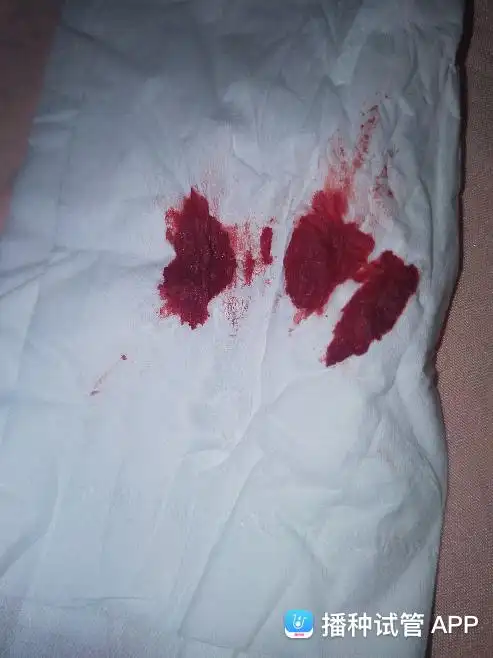 [试管婴儿],移植14天后第一次返院,hc