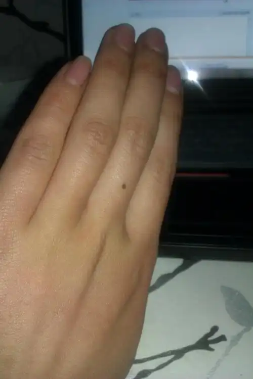 同问左手中指中间有颗黑痣手相和面相大全 手相面相 > 女人手上长痣