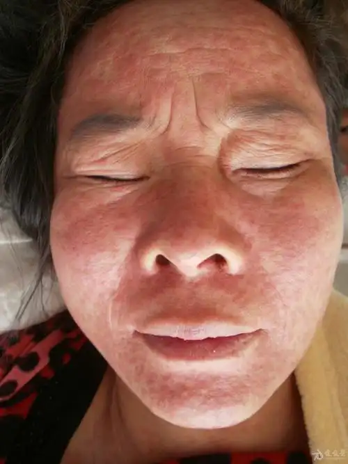 皮肤病成人麻疹