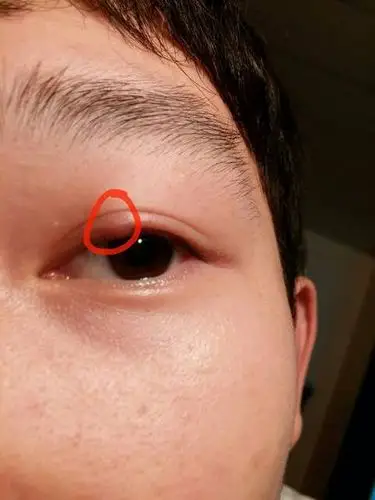 问:左眼皮下眼皮有点红肿怎么回事,不痛不痒按下去也没感觉,已经3天了