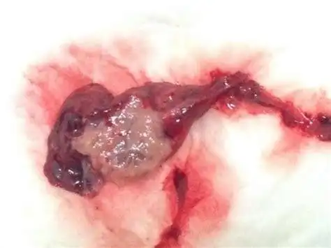 怀孕40多天流产反应