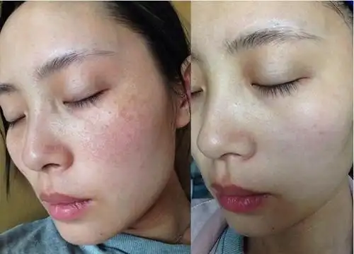 教你一块钱的土豆 ,简单美白祛斑!