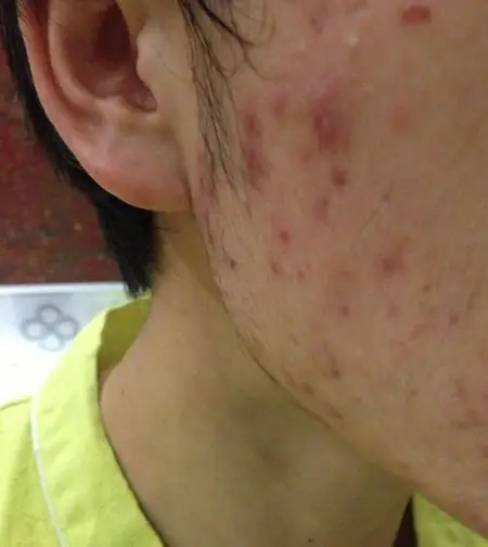 脸上张红色痘痘很多!