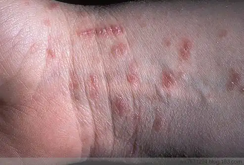 当感染疥疮之后怎么办 - 清丰 - 网络中医堂