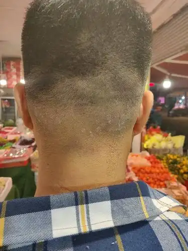 后脑勺白斑.好恶心,求助用什么药