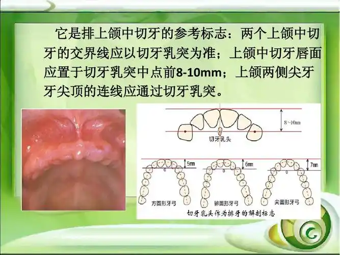 它是排上颌中切牙的参考标志:两个上颌中切 牙的交界线应以切牙乳突为